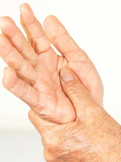 Things To Know About Rheumatoid Arthritis